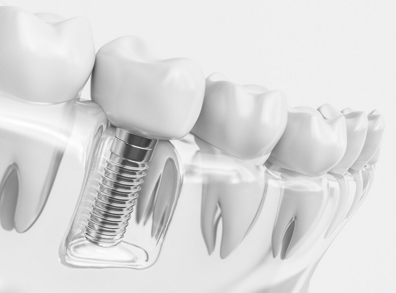 What To Expect After Having Dental Implant Surgery?