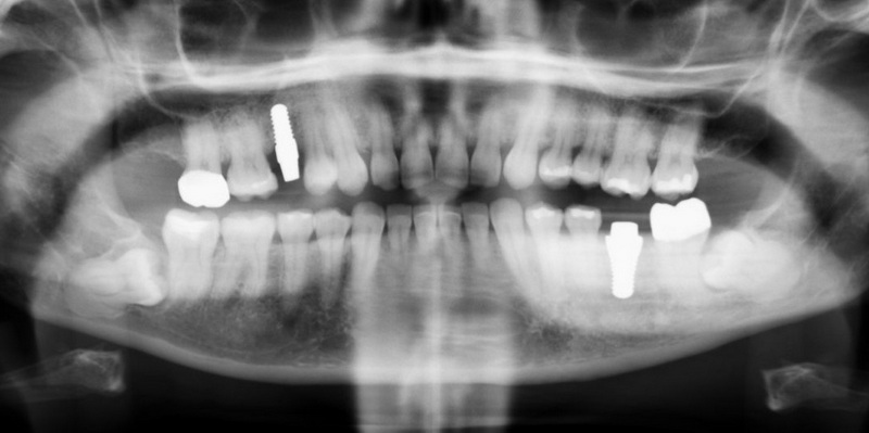 can dental implant cause trigeminal neuralgia