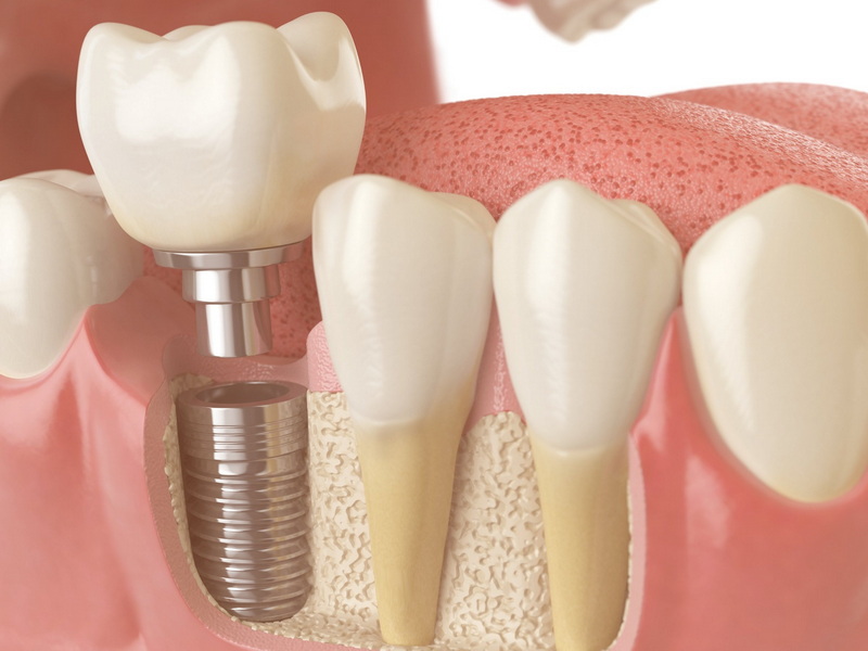 can diabetic have dental implant