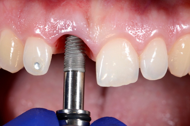 where does bone graft for dental implant come from