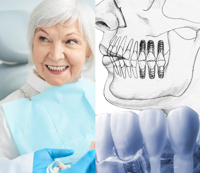 who qualifies for dental implant grants