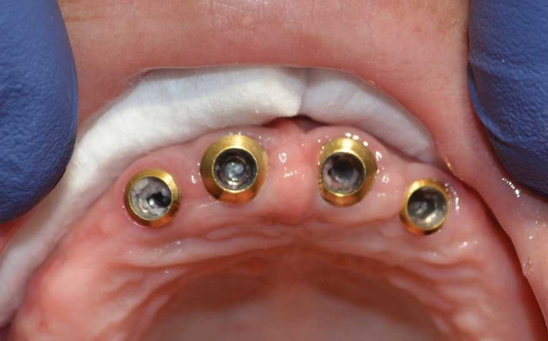 dental implant abutment screw loosening