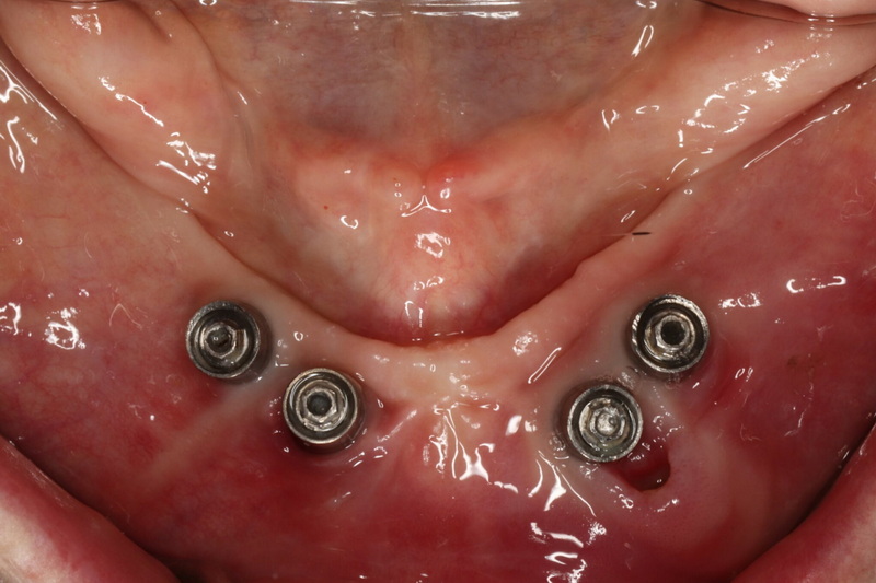 Is An Implant Abutment Screw Fracture A Sign of Implant Failure?