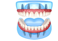 //iirorwxhloqjli5p.ldycdn.com/cloud/llBpkKloljSRrlmkjrljjo/average-cost-of-dental-abutment.jpg