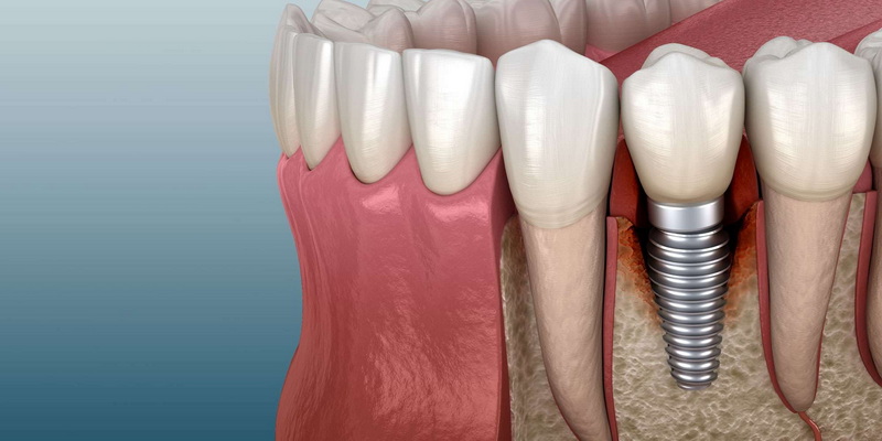 Can Incorrect Abutment Screw Preload Lead To Implant Failure?