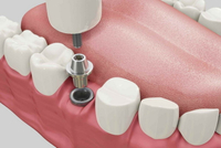 //iirorwxhloqjli5p.ldycdn.com/cloud/llBpkKloljSRrlnipjrljo/can-i-eat-pancakes-after-dental-implant-surgery.jpg