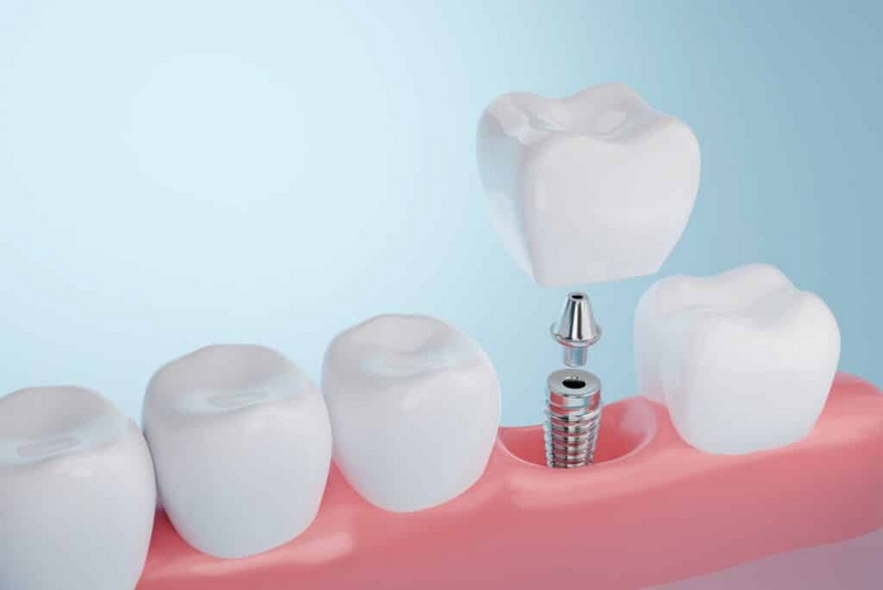 are dental implant expenses tax deductible