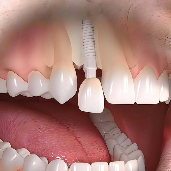 can i pay for a dental implant with hsa funds