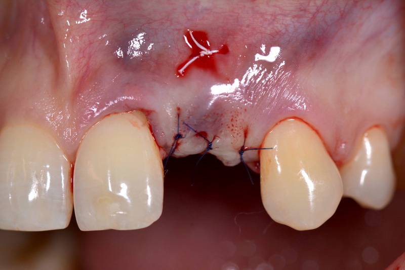 can a dental implant affect singing