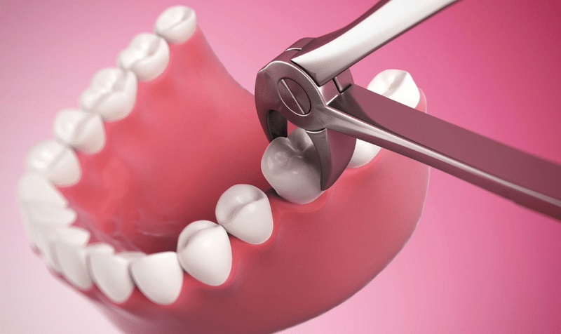 Can A Crown Be Placed over A Dental Implant?
