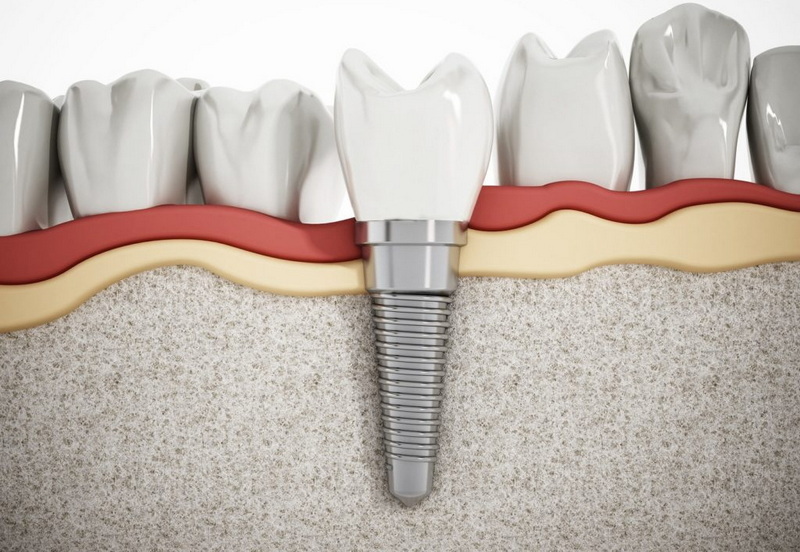 can a dental implant be done in one visit