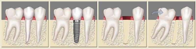 can a laptop affect dental implant