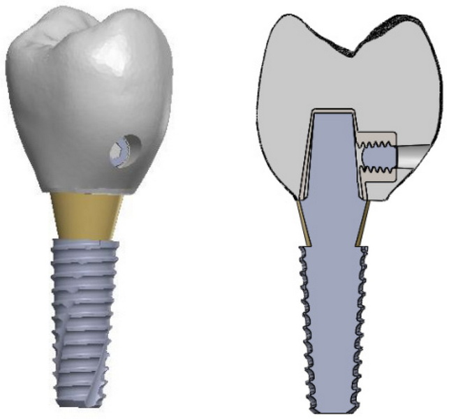 How Long Does Dental Abutment Pain Last?