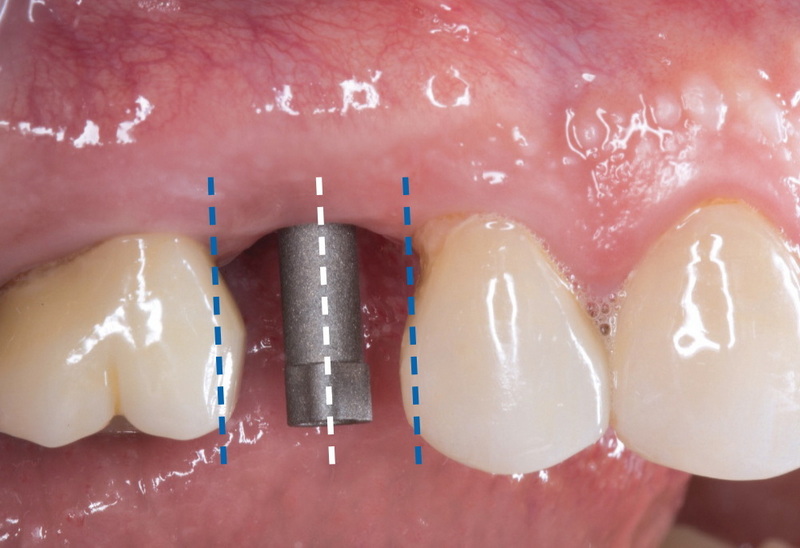 can you smoke after dental implant cleaning