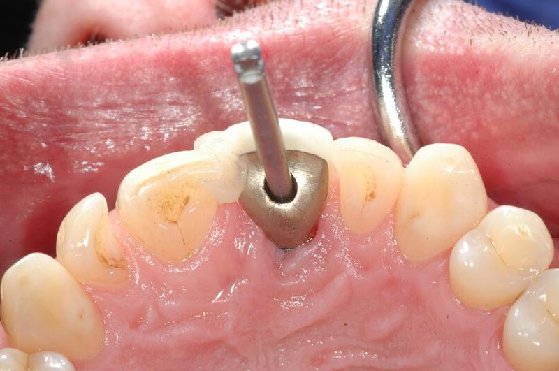 Can You Smoke After Getting A Dental Implant?