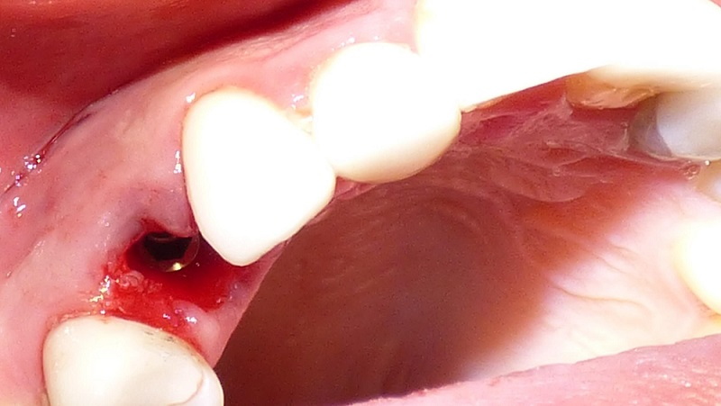 Is Dental Implant Painful Quora?