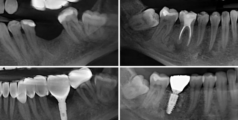 what can i drink after dental implant surgery