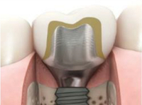 //iirorwxhloqjli5p.ldycdn.com/cloud/lmBpkKloljSRiljjlrjljn/astra-ev-uni-healing-abutment.jpg