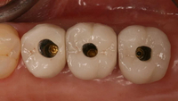 //iirorwxhloqjli5p.ldycdn.com/cloud/lmBpkKloljSRillikirnjn/implant-abutment-screw-removal-kit.jpg
