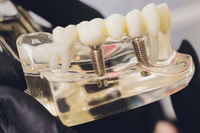 //iirorwxhloqjli5p.ldycdn.com/cloud/lmBpkKloljSRilliknjmjo/3-high-healing-abutment.jpg