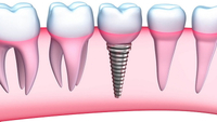 //iirorwxhloqjli5p.ldycdn.com/cloud/lmBpkKloljSRilliknkpjo/17-degree-healing-abutment-zygoma.jpg