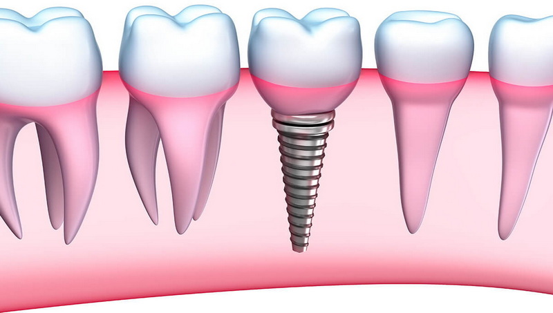 17 degree healing abutment zygoma