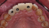 //iirorwxhloqjli5p.ldycdn.com/cloud/lmBpkKloljSRilliorkrjn/implant-abutment-screw-design.jpg