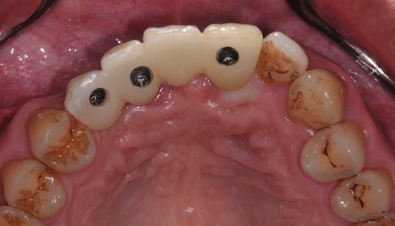 What Is The Best Abutment Screw Design for Anterior Implants?
