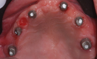 //iirorwxhloqjli5p.ldycdn.com/cloud/lmBpkKloljSRilliqinojo/implant-and-abutment-screw.jpg