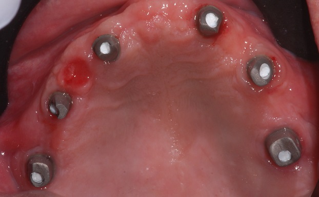 What Torque Settings Are Recommended for Implant And Abutment Screws?