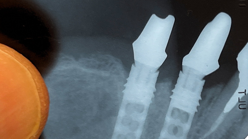 How Do You Select The Right Size Anatomic Healing Abutment Former?