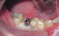 //iirorwxhloqjli5p.ldycdn.com/cloud/lmBpkKloljSRilmiljrpjo/anatomical-healing-abutment.jpg