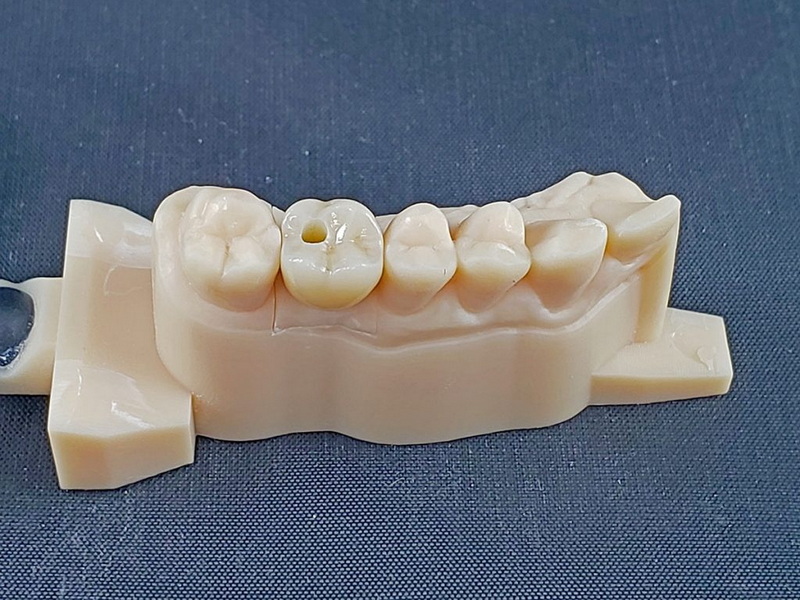What Is The Purpose Of An Atlantis Healing Abutment In Implant Healing?