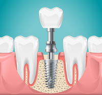//iirorwxhloqjli5p.ldycdn.com/cloud/lmBpkKloljSRilnjmnqojq/does-a-dental-implant-procedure-hurt.jpg