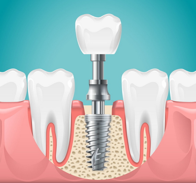 Does A Dental Implant Procedure Hurt?