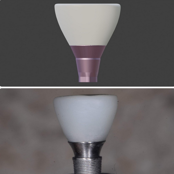 When Should You Choose A BioHorizons Custom Healing Abutment?
