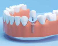 //iirorwxhloqjli5p.ldycdn.com/cloud/lmBpkKloljSRilpjoikljo/does-augmentin-cause-dental-implant-pain.jpg