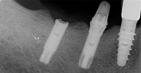 //iirorwxhloqjli5p.ldycdn.com/cloud/lmBpkKloljSRilqiqpmjjq/nobel-biocare-abutment-screw-retrieval-video.jpg