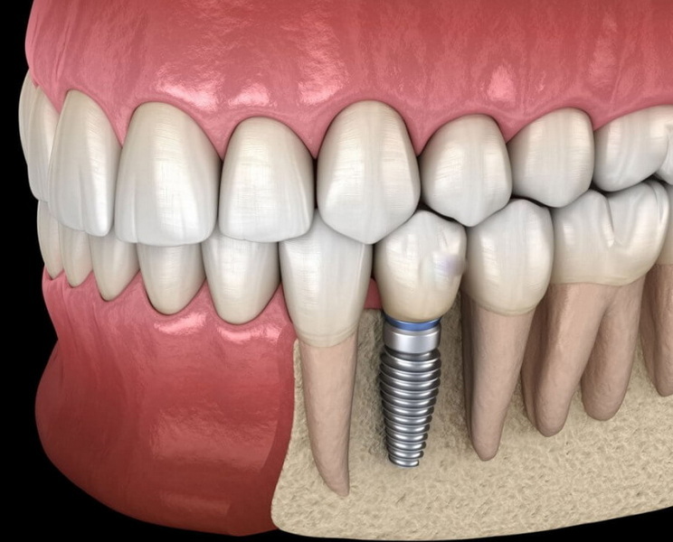 what can you eat after dental implant surgery_14