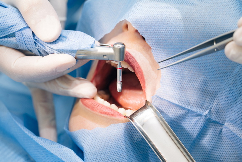 How Long Does Dental Implant Process Take?