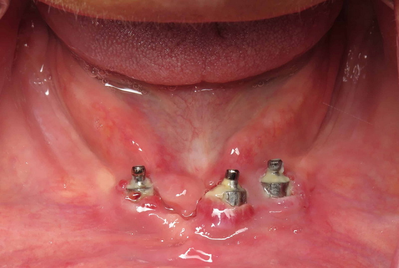 Is Dental Implant Permanent?
