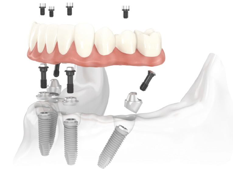 how to heal dental implant fast