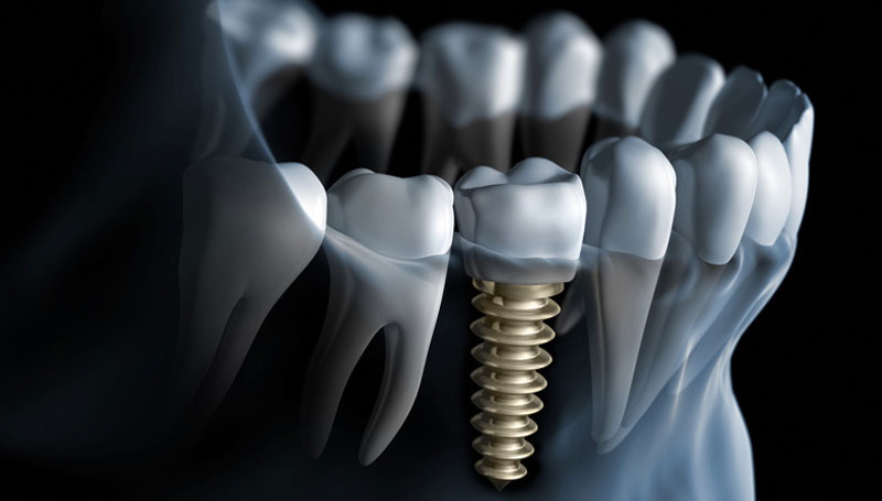 how long after dental implant surgery can i exercise_13