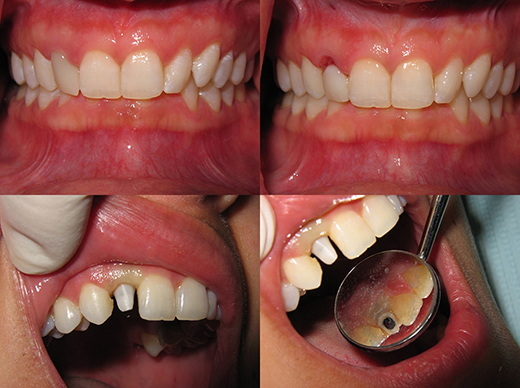 dental implant need to be removed_3