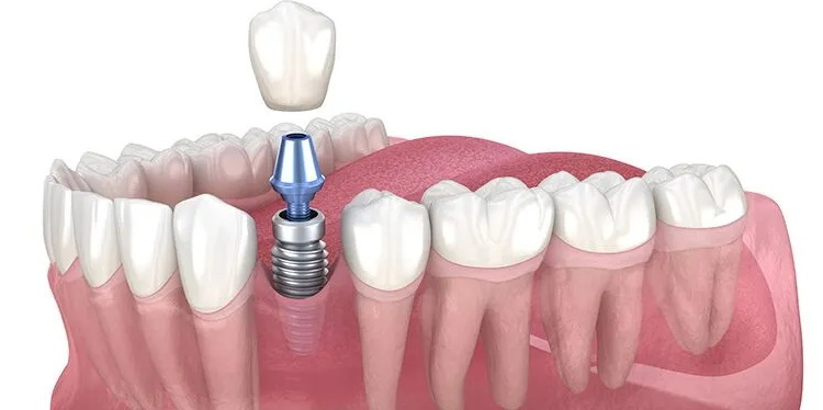 How Long Do Implants Last at A & A Dental Implant and Cosmetic Center?