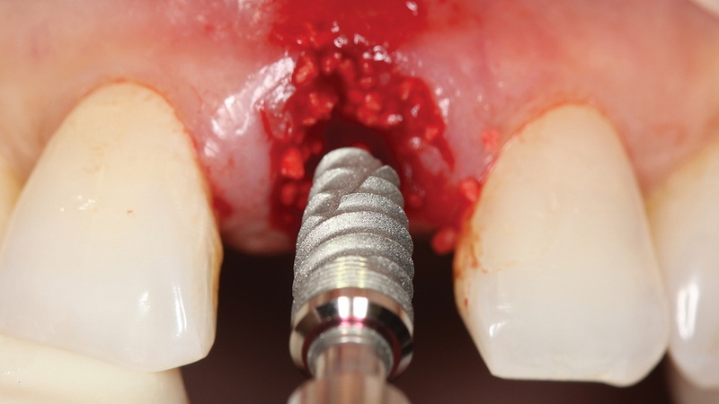 how to sleep after dental implant_03