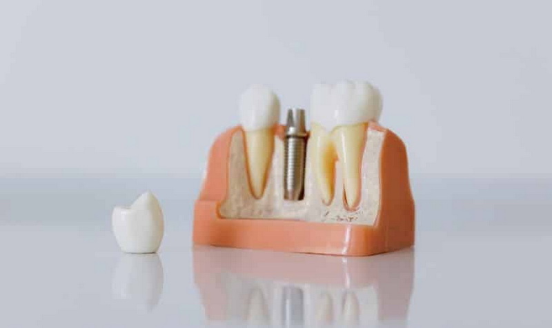 what happens if a dental implant fails_12