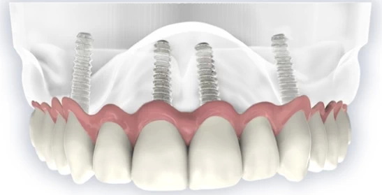 when can i eat solid food after dental implant_3
