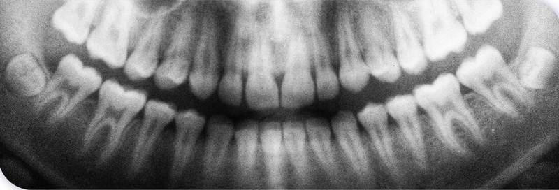 What Happens When A Dental Implant Is Loose?