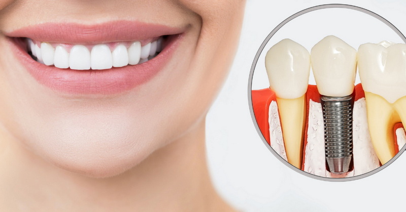  if dental implant screw falls out_1
